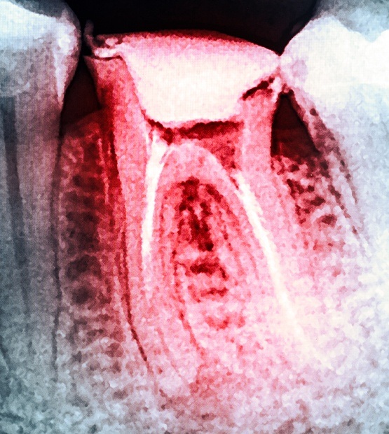 tooth fragments left after extraction